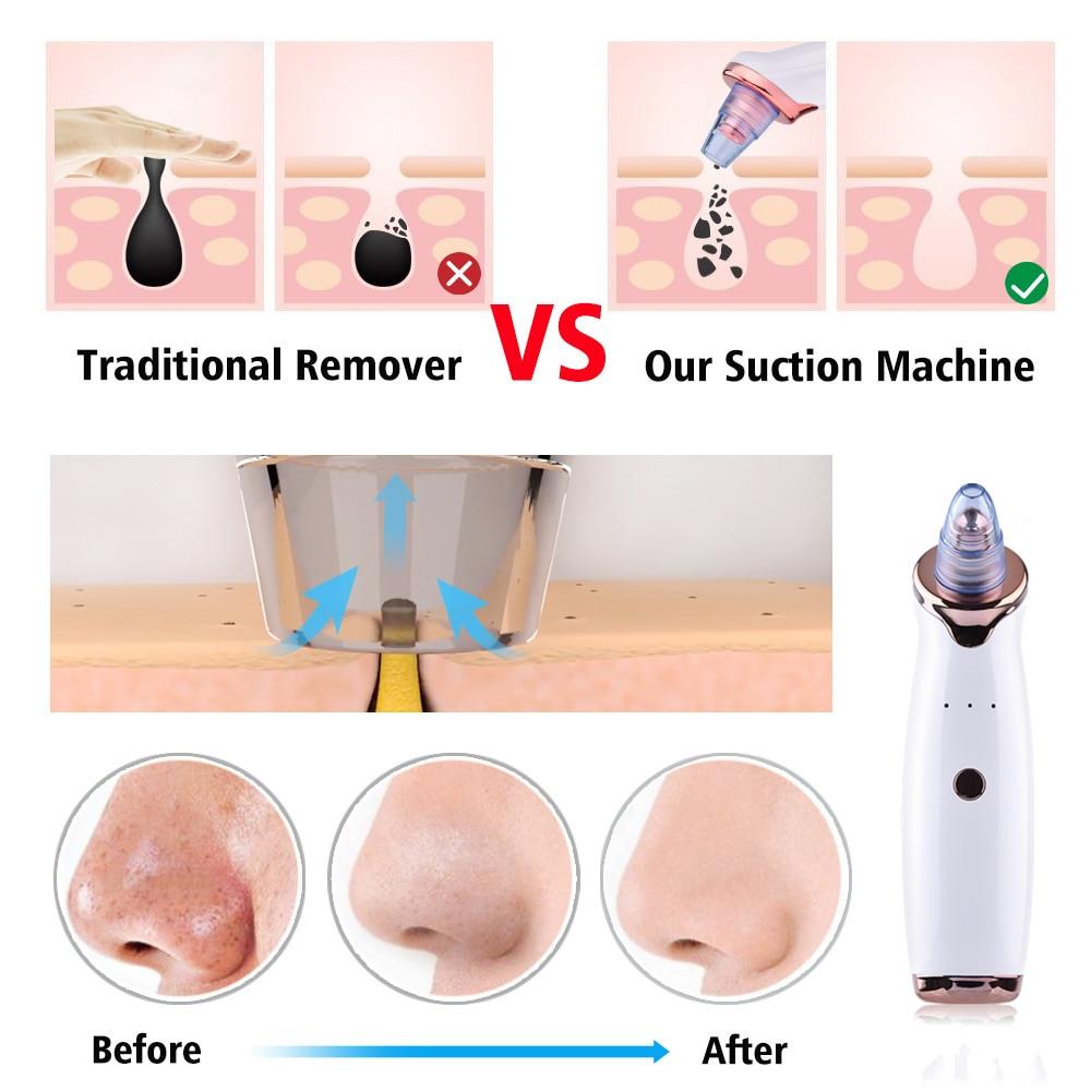 Blackhead Remover Vacuum Pore Cleaner Suction Cleaning Face Care Black Head Cleaner Acne Extractor Diamond
